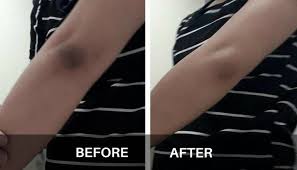 ↓ open this for more info ↓★hey guys! Natural Ways To Lighten Dark Knees And Elbows At Home Htv