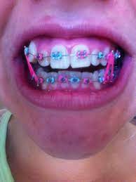 2nd Appointment Braces Colors Braids For Black Hair Braces