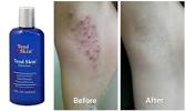 Ingrown Hairs