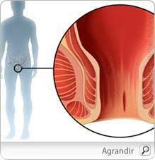 Fissure Anale Facteurs Prevention Et Traitements