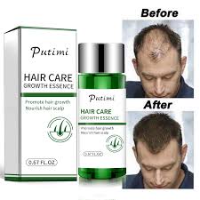 Hair restore biotin hair growth serum is safe to use with zero side effects. Anti Hair Loss Products Natural Ginger Essence Hair Growth Serum Fast Hair Growing Essence Regrowth Hair Growth For Women Men Buy At The Price Of 2 59 In Aliexpress Com Imall Com