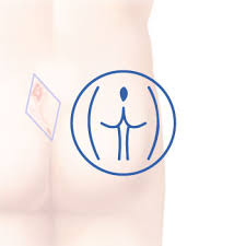 Other surgical procedures include complete cyst and cyst wall excision along with the pilonidal sinus tracts. Pilonidal Sinus Treatment Abu Dhabi Harley Street Colorectal Clinic