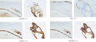 The area where the stomach and esophagus meet is often called the gastroesophageal (ge) junction. Colon Cancer Metastasis Mimicking A Hilar Cholangiocarcinoma A Case Report And Literature Review Surgical Case Reports Full Text
