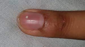 Symptoms can include lack of appetite, diarrhea, fatigue, and poor immune system. What Causes White Spots On Fingernails Learnskin
