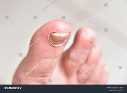 Image result for mykoza nehtů