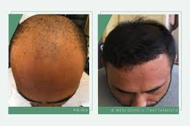 Find out where to post ads for free. Trapianto Di Capelli La Tecnica Micro Fue Dott Valerio De Santis