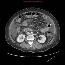 Retroaortic Left Renal Vein Radiology Reference Article Radiopaedia Org