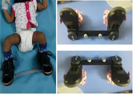 Peruse this page and take a look at our shoe videos for employee reviews and more. Creative Op Solution On Twitter Club Foot Shoes Without Bar Shoes For Clubfoot Toddlers Clubfoot Shoes Online Clubfoot Shoes In India Club Foot Shoes Price In India Clubfoot Ctev Clubfootshoe Clubfootsplint Ponsettisplint