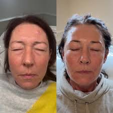 Real talk — collagen production naturally slows down from our mid-20s,  which is why collagen banking is such a game changer. Treatments like  microneedling help your skin build and preserve collagen, improving