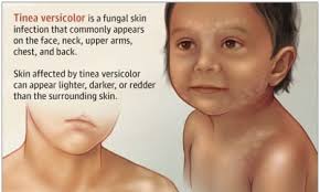 You and your doctor can discuss the best treatment. Tinea Versicolor Know More About It By Dr Radhika A Md Lybrate