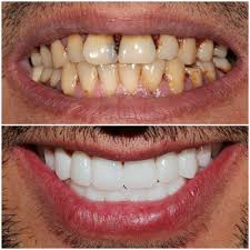 Smile Makeover Turkey Dental Crowns Dental Dental Veneers