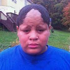 Receding hairline on one side can be due to multiple causes like. Bad Hair Day Funny Hairlines Bad Haircut Bad Hair