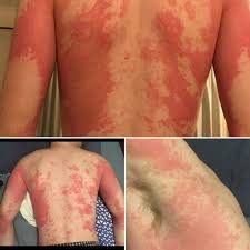 When a rash appears on any part of the body, the skin become red, swollen and blotchy. Skin Rash Is Coronavirus Sign And Should Be Fourth Official Symptom Experts Warn The 8 Different Types Revealed