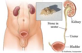 Pin On Kidney Stone Surgery
