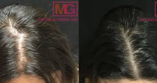 Androgenic hair loss in females is caused by the interaction of testosterone, the male hormone, and dihydrotesterone (dht). What Causes Hair Loss And How To Effectively Treat It