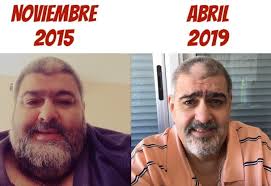 EL PACIENTE CON MAYOR EXCESO DE PESO OPERADO POR NUESTRO EQUIPO.  ............. POR CONSULTAS LLAMAR AL 099138500. LUNES A VIERNES DE 10 A 18  Sin dudas el caso de Horacio es uno