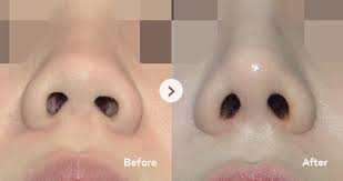 Different types of noses front view. Nose Surgery By Type Vip Plastic Surgery Korea