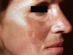 When it occurs in pregnancy, it's called chloasma. Melasma Causes Treatment Affects Skin Of Color Society