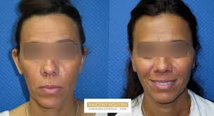 Sont en bonne santé : Oreilles Decolees Operation Chirurgie Esthetique Paris 17