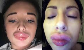 People doing @home fillers... : rBotchedsurgeries