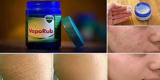 Vicks Vaporub Uses For Varicose Veins Mentholatum