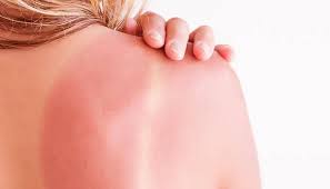 طرق علاج حروق الشمس النهار