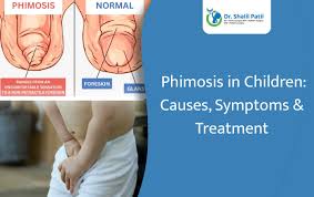 Image result for Phimosis