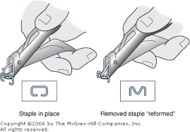 Putting staples is considered to be a better option by surgeons because of this reason, you need an experienced surgeon to remove surgical staples with utmost care. 17 Suturing Techniques And Wound Care Clinicians Pocket Reference 11th Edition