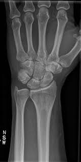 Tfcc or the triangular fibrocartilage complex is a cartilaginous structure located around the wrist region which provides support and cushions the carpal bones in the wrist. Triangular Fibrocartilage Complex Tfcc Injury Melbourne Hand Surgery