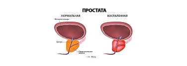 Prostatit U Muzhchin Priznaki Prostatita Ostryj I Hronicheskij Prostatit