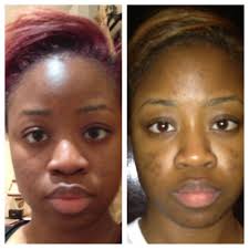 These products help to diminish dark spots and acne scars. Getting Rid Of Dark Spots And Acne Marks With Local Home Remedies Okpeke Fashion Beauty Health Portal Fashion Blogs In Nigeria Fashion Bloggers In Nigeria Fashion News In