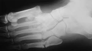 An injury that goes untreated can cause the foot bone to lose calcium and cause fractures, sores or change the shape of your foot. Charcot Foot Causes Symptoms And Treatment