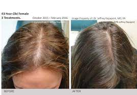 Could you tell me please how to do this? How To Fix Hair Loss Or Hair Thinning Enliven Aesthetics Dermal Fillers Specialists In San Diego Botox Dysport Sculptra Galderma