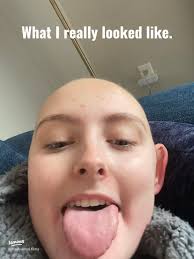 Unfiltered Insights: My Real Journey Through Cancer Treatment