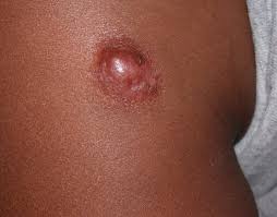 Image result for Dermatofibrosarcoma Protuberans