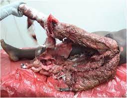 Degloving Injuries With Versus Without Underlying Fracture In A Sub Saharan African Tertiary Hospital A Prospective Observational Study Abstract Europe Pmc