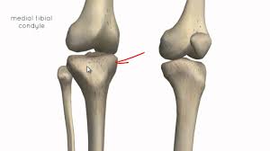 Knee osteoarthritis causes pain and limits your mobility. Knee Part Ii Find A Physio