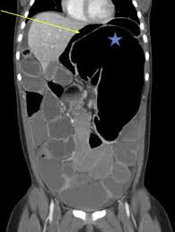 Image result for Volvulus