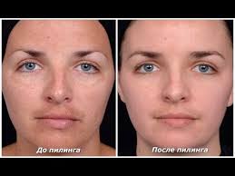 как сузить поры на лице в домашних условиях видео Kak Umenshit Pory Na Lice Profilaktika Dlya Suzheniya