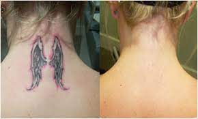 They have performed over 15,000 tattoo removal procedures. Vanish Ink Laser Tattoo Removal