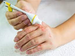 Hydrocortisone: Uses and Safety Considerations | Poison Control