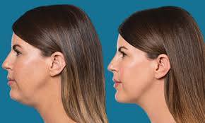 Check spelling or type a new query. Enlever Le Double Menton Sans Chirurgie Avec Kybella