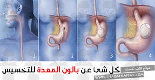 ١٤ سؤال و جواب حول بالون المعدة للتخسيس وهل له نتيجة ثقف نفسك