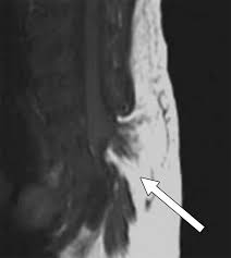 Image result for Spinal Dysraphism