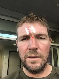 Thanks to Pete Smith of Falcon Tree Services for his quick reaction and  excellent First Aid skills to prevent me having a worse scar