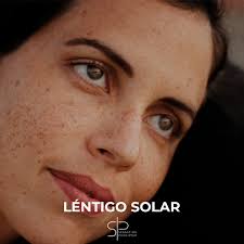 Crema para quitar las pecas de la cara y piel. Como Quitar Las Manchas En La Cara Por Un Dermatologo Experto