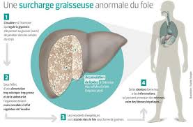 Le diagnostic n'est pas très difficile à faire, lorsqu'elle survient au lendemain d'un bon repas, très copieux, plutôt riche et généralement. Steatose Hepatique Quand Le Gras Rend Malade Le Foie