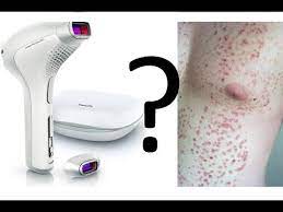 Lumea comfort ipl hair removal system enables a sliding motion for a more convenient and continuous application. Ipl Laser Hair Removal Bad Safe Side Effects Youtube