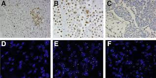 Conversely, elevated levels of hyaluronic acid (ha) in effusions are sensitive indicators of mm, although specificity is insufficient. Differential Diagnosis Of Malignant Pleural Mesothelioma On Cytology The Journal Of Molecular Diagnostics