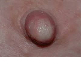 Diabetes / sukkersyke kan gi brennende symptomer og nummenhet i huden og på kroppen. Hvite Brystknopper Og Raynauds Fenomen Ammehjelpen